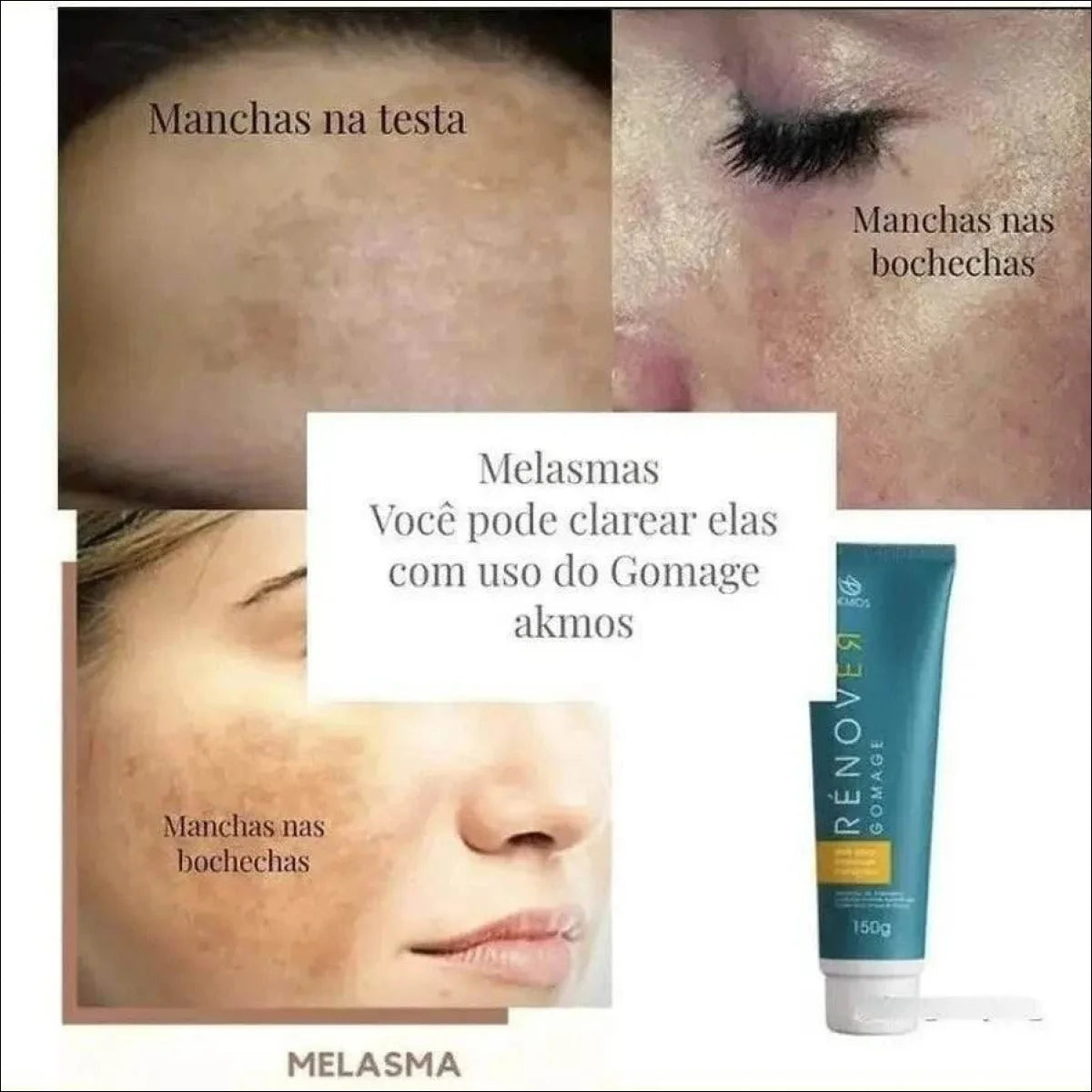 Kit 2 Pomada Tirar Manchas Intimas: Virilha, Axilas, Mamilos - Jm Grife
